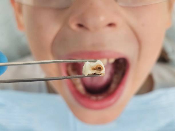 Best Emergency Treatment for Dental Infections or Abscesses in Fairfield, IL